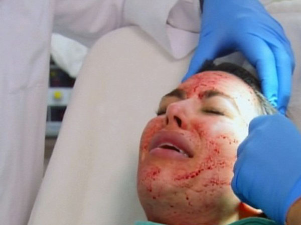 Kim Kardashian se inyecta su propia sangre en la cara para mantenerse joven