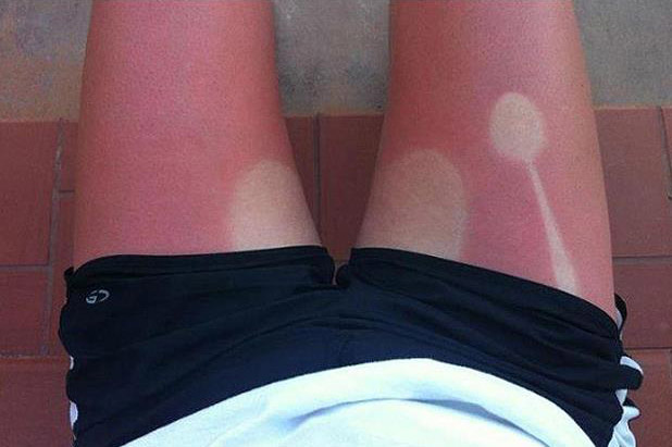 Las peores quemaduras de sol (Fotos)
