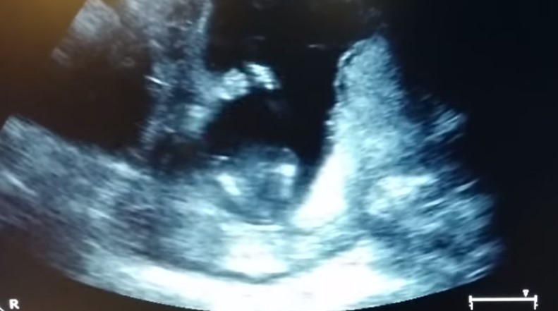 ¡Increíble! Bebé de 14 semanas de gestación aplaude durante una ecografía (Video)