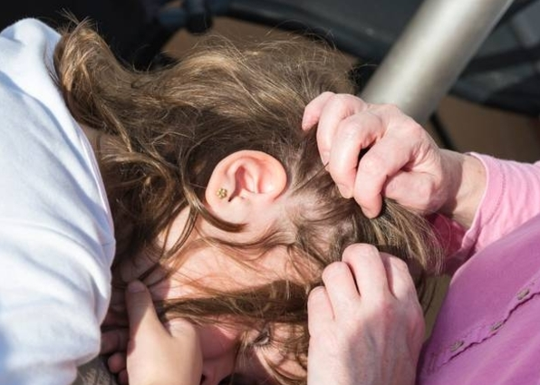 Impactante caso de una niña con más de 15 mil piojos en la cabeza (Video)