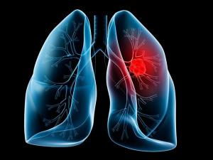 Estas son las seis posibles causas de cáncer de pulmón que seguramente no conocías
