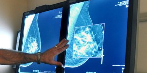Identifican el gen responsable de las metástasis del cáncer de mama a los huesos