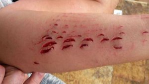 La feroz mordedura de un tiburón a una turista en Canarias