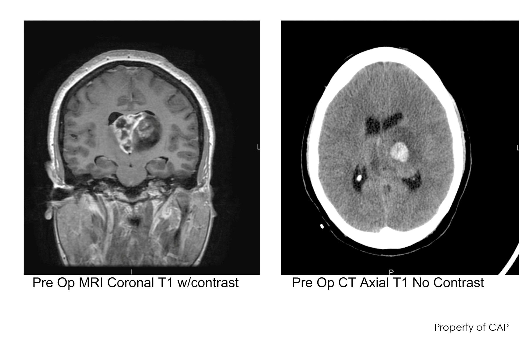 Cáncer diagnosticado al senador estadounidense McCain es uno de los más letales