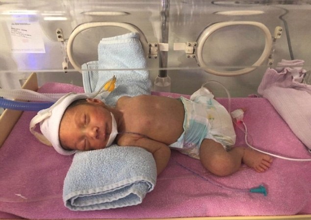 Bebé que nació con “dos cabezas” en Siria fue operado con éxito (FOTOS)