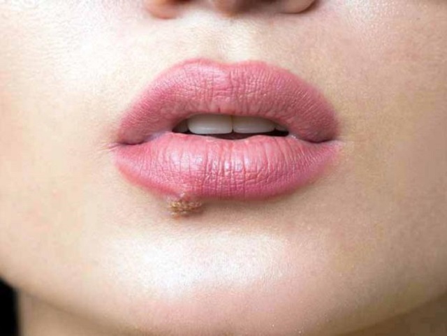 A cuidarse… Los herpes pueden causar enfermedades mentales