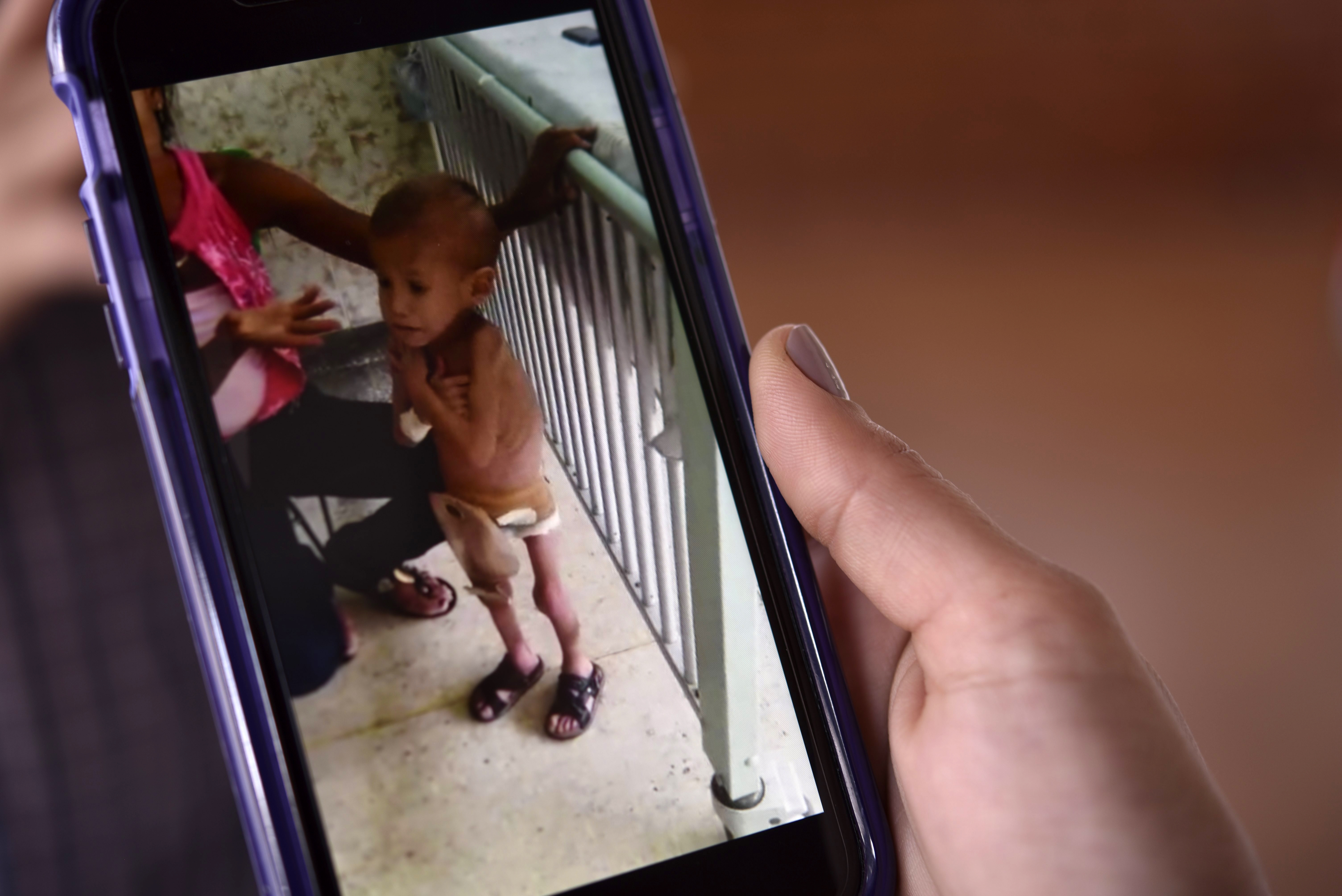 La desnutrición no deja de cobrar vidas en Ciudad Guayana