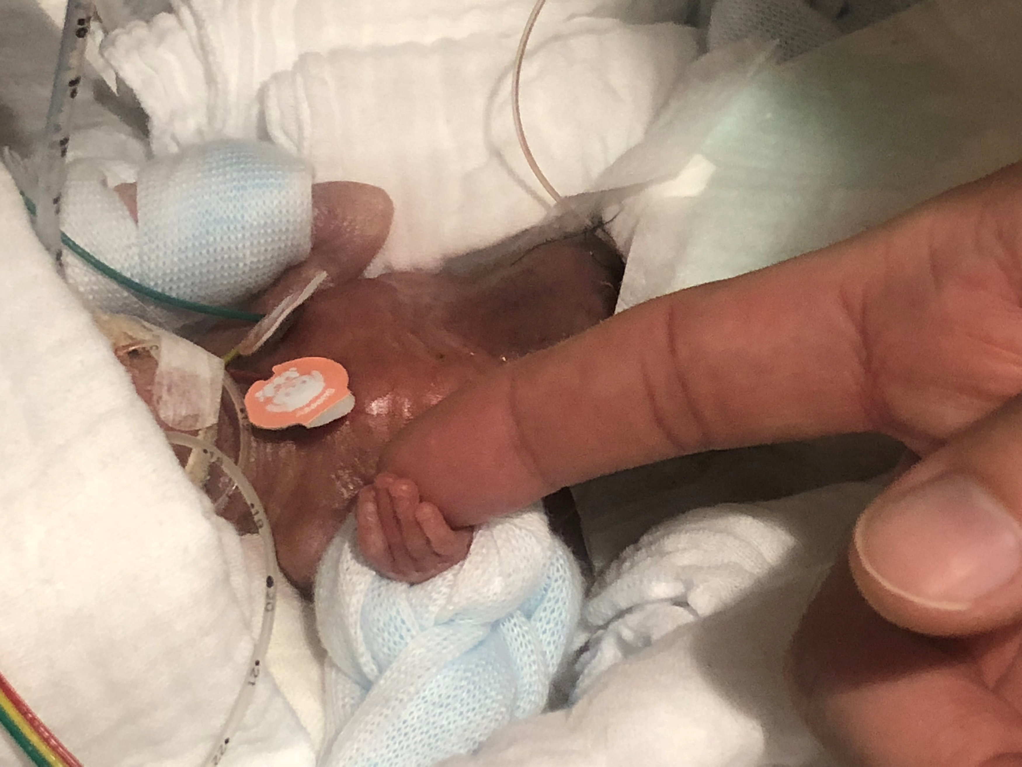     Un bebé prematuro que pesó 268 gramos al nacer salió ...