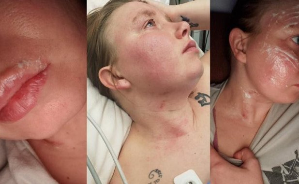Una mujer de Arkansas dice que la parrilla de un restaurante “explotó” en su cara