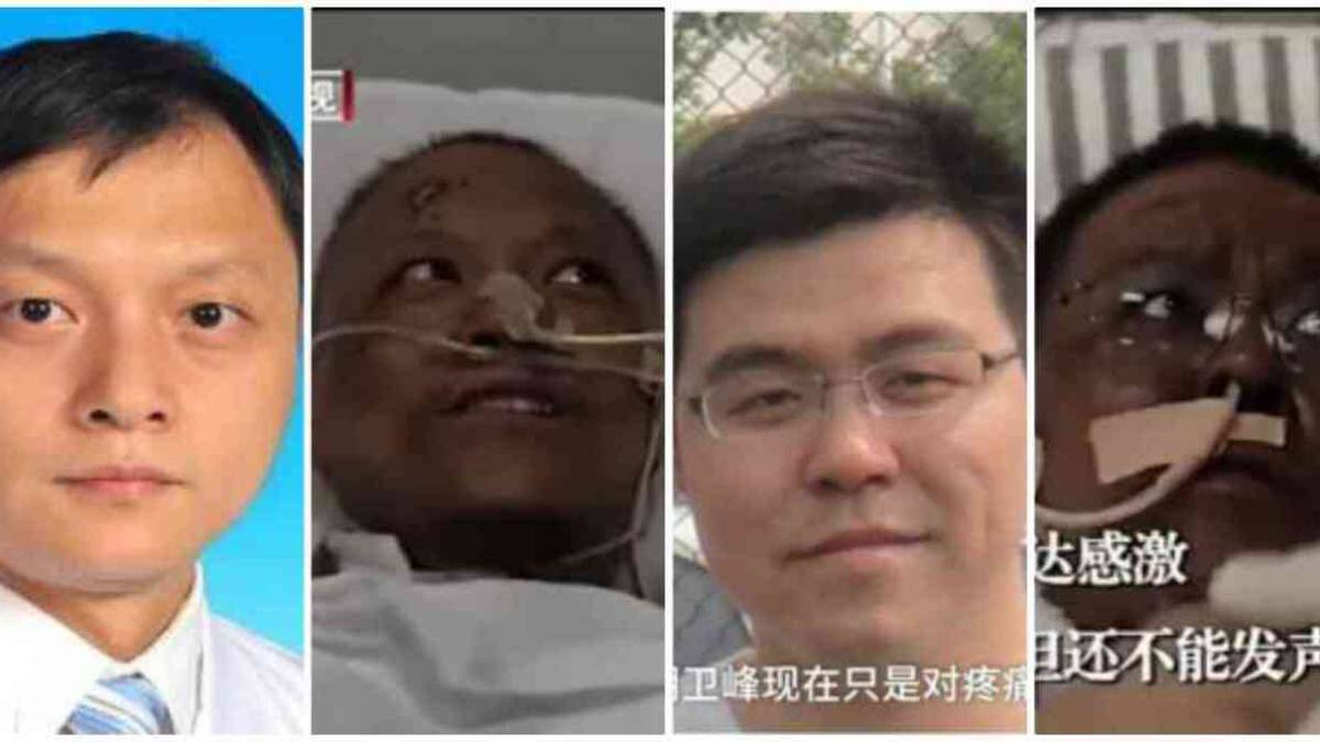 Problema hepático por Covid-19 causa ennegrecimiento a dos médicos chinos