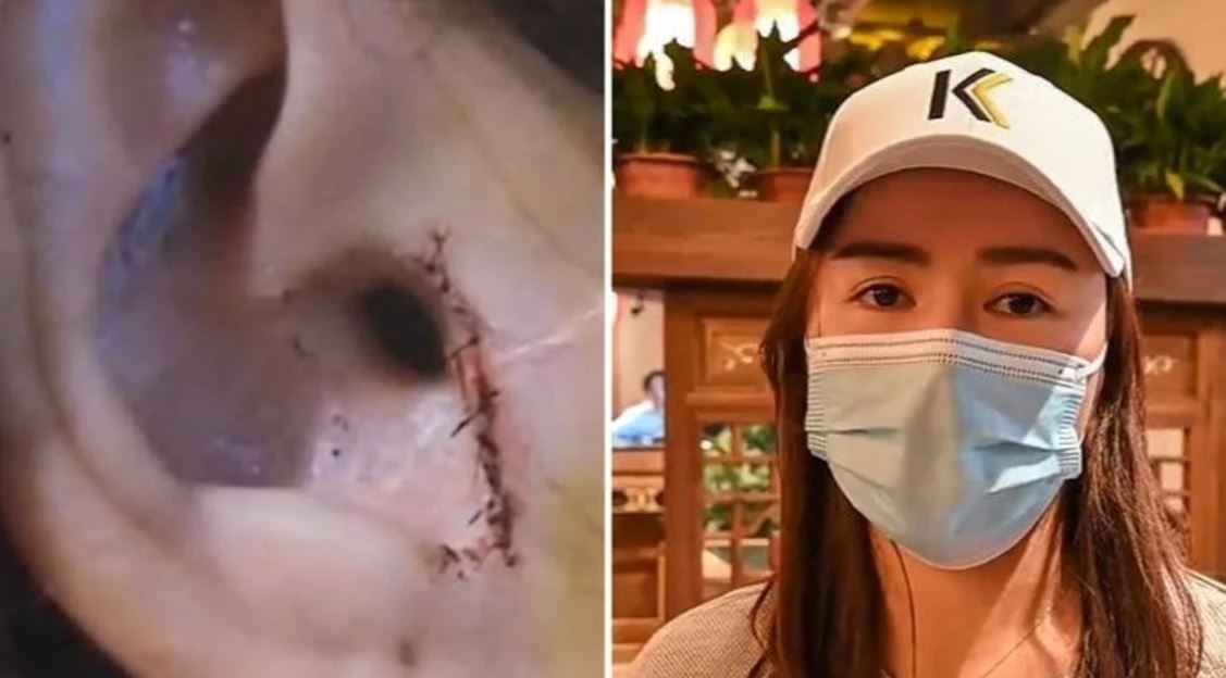 En China, una mujer entró al quirófano para una rinoplastia y salió sin un pedazo de oreja