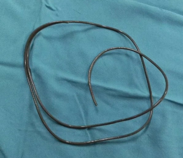 Introducido por el pene: Encontraron un cable de 84 centímetros atorado en la vejiga de un hombre en Indonesia