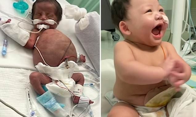 Nació con una rara condición médica en EEUU, pero le dieron de alta justo antes de su primer cumpleaños