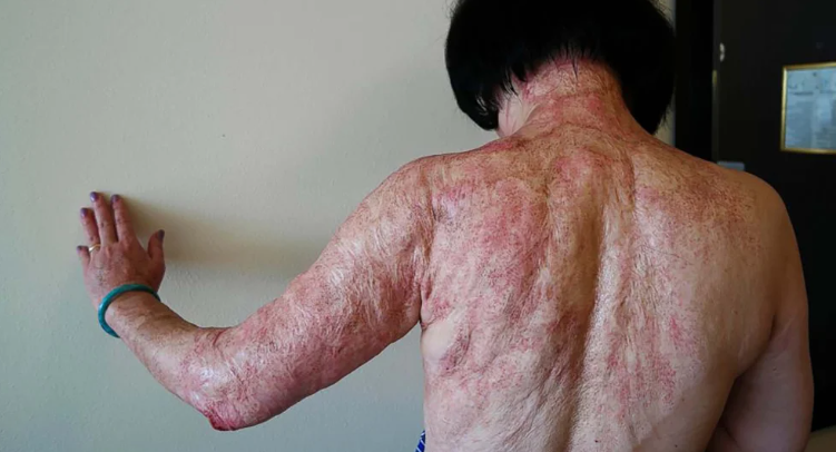 La “niña del napalm” de Vietnam culminó 50 años después un tratamiento para sanar su piel de las quemadas