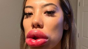 Mujer de Las Vegas se inyectó relleno labial y el resultado fue inimaginable