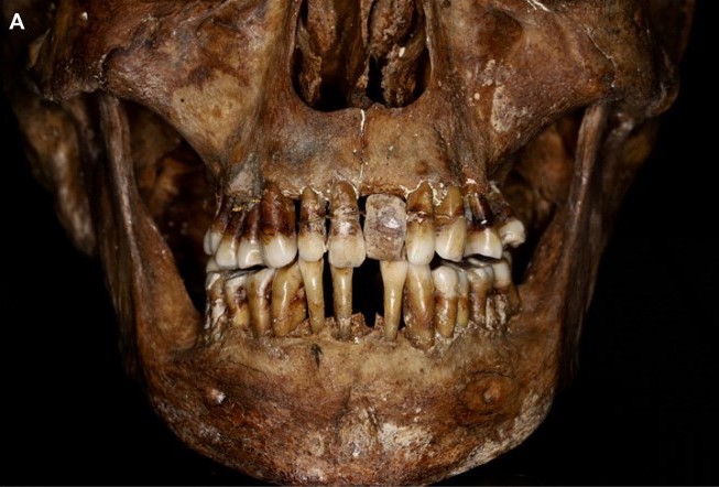 Secretos más íntimos de una aristócrata del siglo XVII en Francia quedaron al descubierto con el estudio de su dentadura
