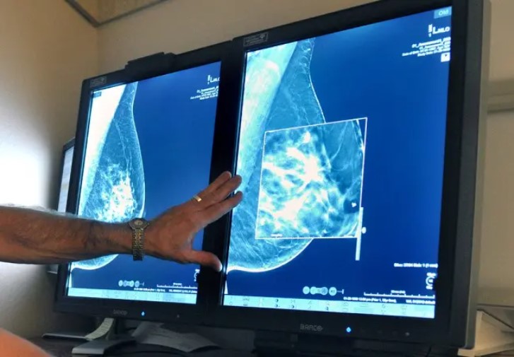 Por qué hacerse mamografías a partir de los 40 años en vez de a los 50, según un influyente grupo en EEUU